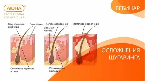 Почему после шугаринга
