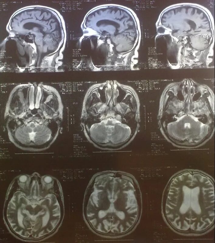 Магнитно резонансная томография головного мозга энцефалопатия. Энцефалопатия на мрт. Диффузные изменения головного мозга на мрт. Дисциркуляторной энцефалопатии. Диффузный характер головного мозга
