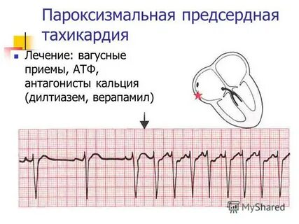 Сколько живут с тахикардией