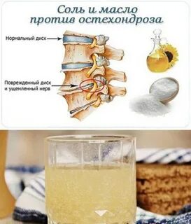 Остеохондроз соли