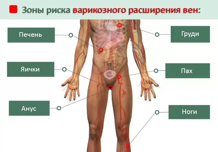 Вена в паху у мужчин. Варикозное расширение вен. Расширение вен паховой области. Варикозное расширение вен в паховой области.