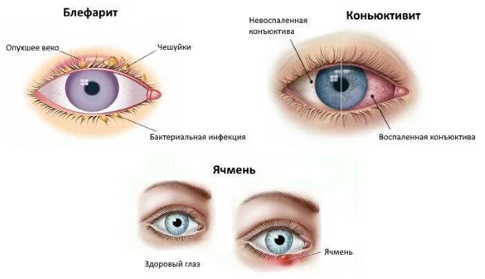 Чем отличается конъюнктивит. Конъюнктивит век ячмень блефарит. Блефарит (воспаление края век). Коньюктивит коньюктивит коньюктивит. Блефарит, конъюнктивит и кератит..