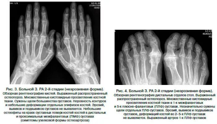 Артрит рентгенологические стадии. Ревматоидный артрит 2 стадии рентген. Ревматоидный артрит кисти рентген. 2 Рентгенологическая стадия ревматоидного артрита. Псориатический артрит кистей рентген.