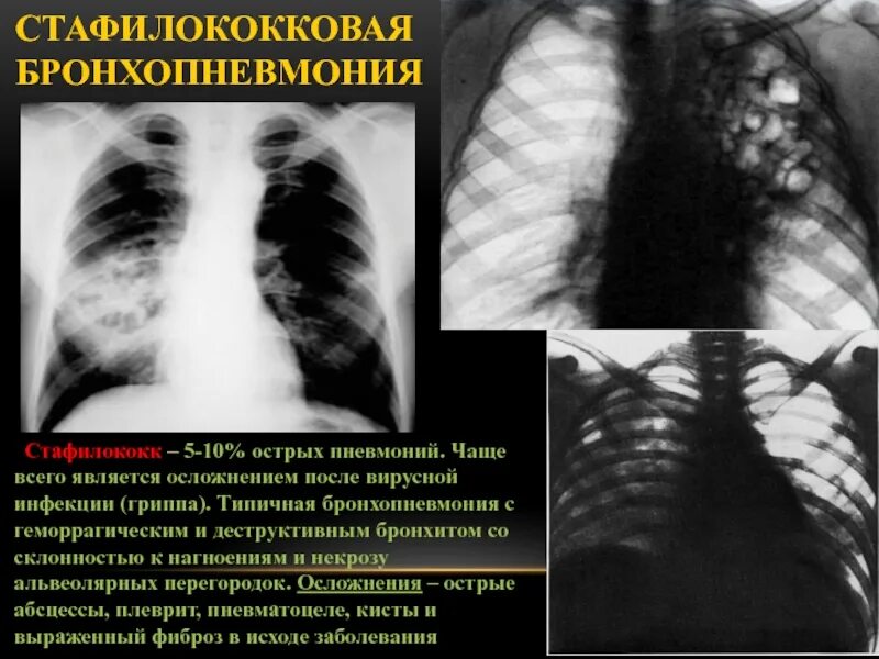 Стафилококковая пневмония рентген. Стафилококковая деструкция легкого. Стафилококковая абсцедирующая пневмония. Стафилококковая бронхопневмония.
