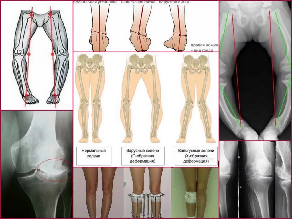 Вальгусная деформация коленных суставов рентген. Варусная деформация коленных суставов. Вальгус коленных суставов. Вальгусная и варусная деформация.