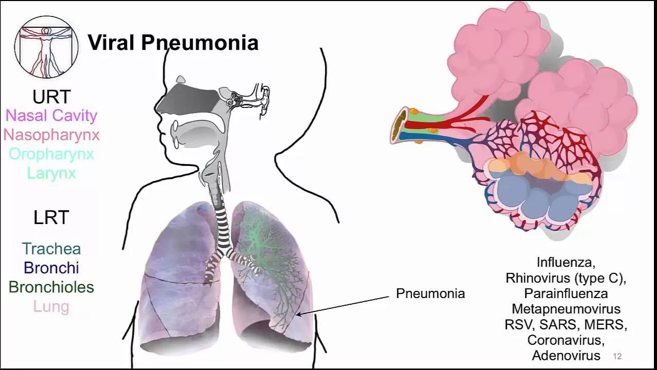 Respiratory virus. Метапневмовирусная инфекция. Метапневмовирус возбудитель. Метапневмовирусная инфекция у детей. Метапневмовирус человека.