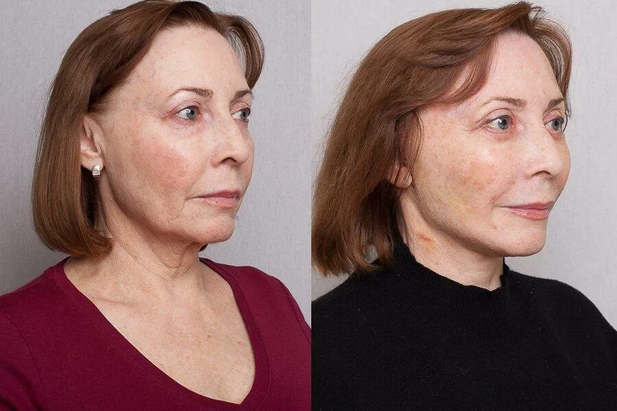 Что нельзя делать после смас лифтинга. Смас лифтинг до и после.