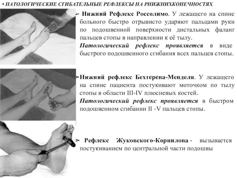 Рефлексы Бабинского и Россолимо. Рефлекс Жуковского Корнилова. Кистевой симптом Россолимо. Патологические симптомы Россолимо.