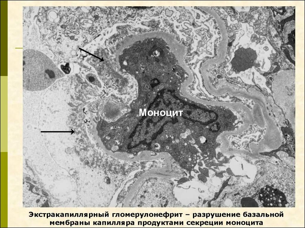 Мембранозный гломерулонефрит патанатомия. Строение фильтрационной мембраны почек. Синдром альпорта патогенез. Почки при синдроме альпорта. Строение базальной мембраны эпителия гистология.