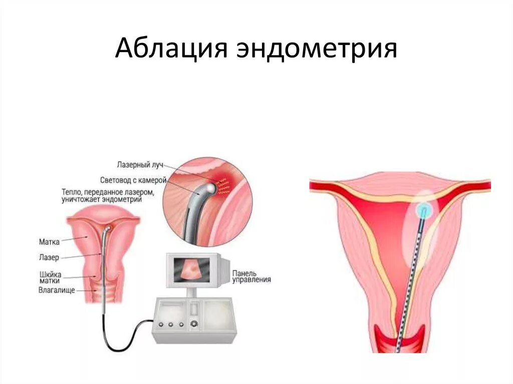 Гиперплазия эндометрия эндометрит. Полип цервикального канала.