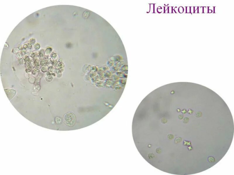 Лейкоциты в моче микроскопия. Исследование осадка мочи лейкоциты. Лейкоциты и эритроциты в моче микроскопия. Лейкоциты в моче микроскопия осадка.