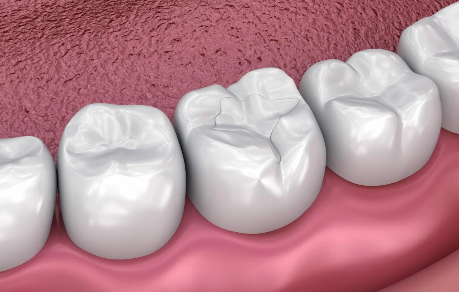 Tooth filling