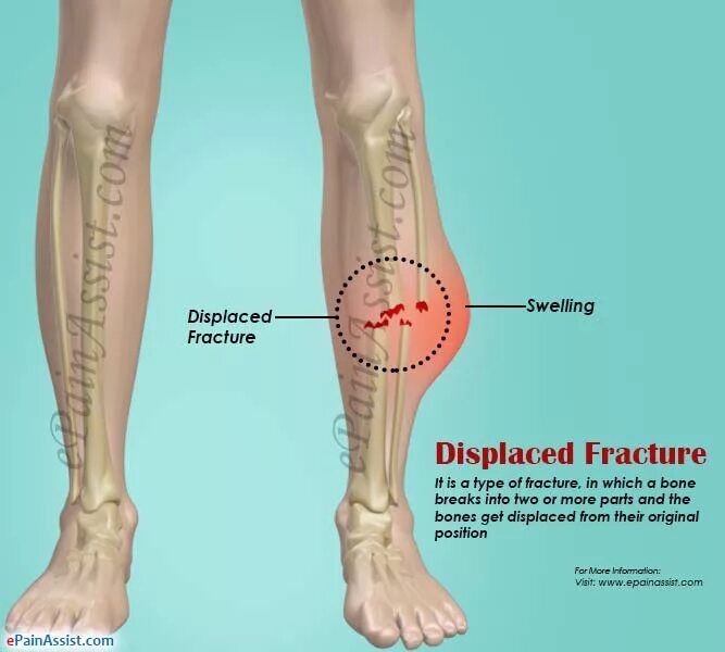 The fracture can be. The fracture can be