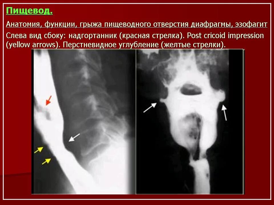 Пищевод шацкого. Дивертикул пищевода кт мрт. Ценкеровский дивертикул пищевода.