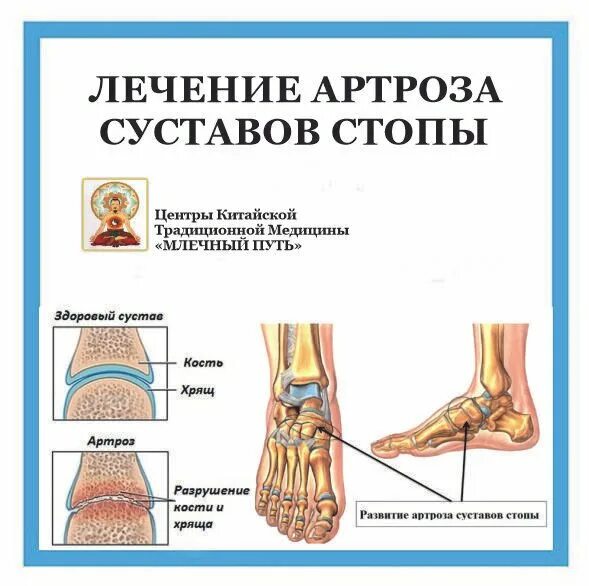 Можно ли вылечить артроз. Остеоартроза суставов стопы. артроз мелких суставов стопы.