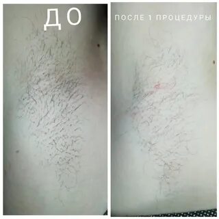 Избавиться от волос на теле навсегда
