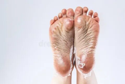 Wrinkled foot