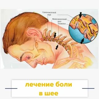 Шейный позвонок защемление нерва