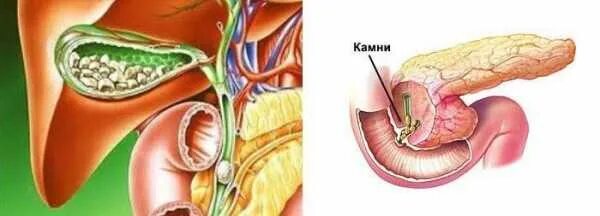 Камни в желчном пузыре обострение симптомы. Камни в желчном пузыре симптомы симптомы. Камни в жёлчном пузыре симптомы. Камни в жёлчном пузыре симптомы у мужчин. Камни в жёлчном пузыре симптомы у женщин симптомы.