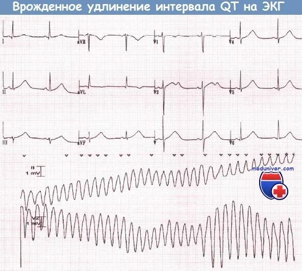 Удлиненное qt на экг. Синдром удлиненного qt на ЭКГ. Синдром удлиненного интервала qt на ЭКГ. Интервал qt на ЭКГ. Удлинённый qt на ЭКГ.