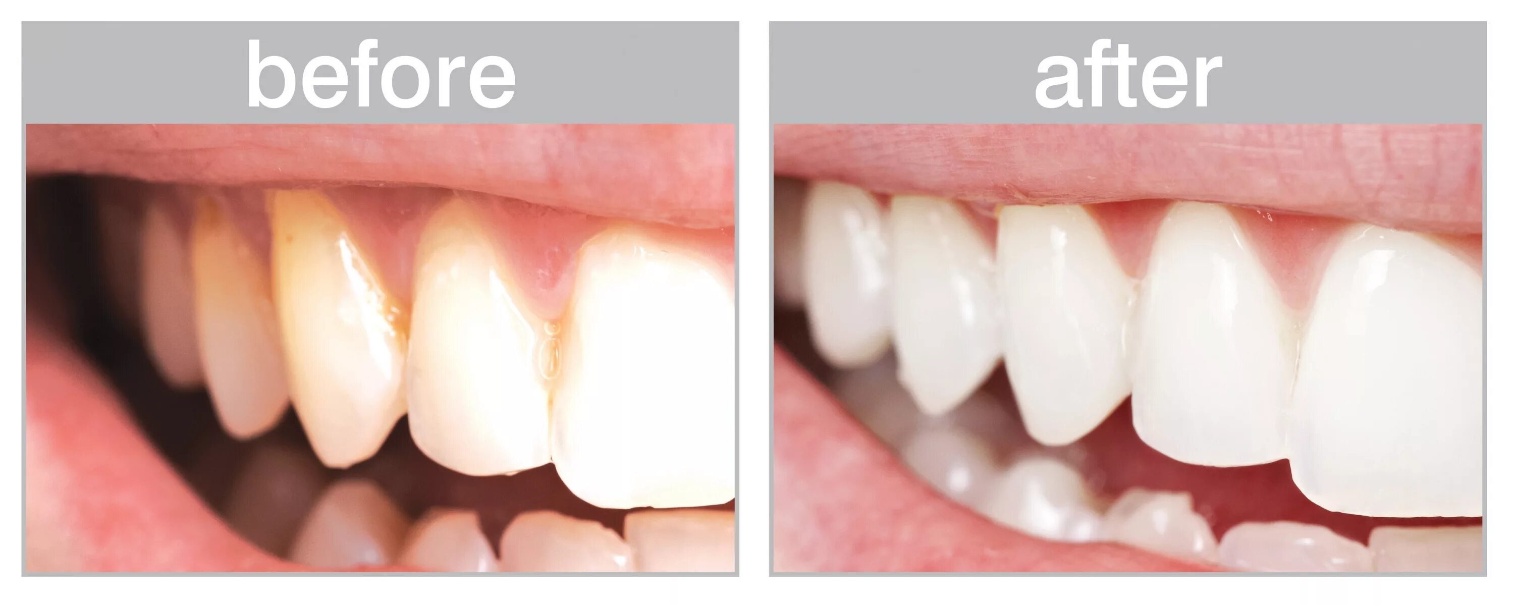 После чистки зубов можно ли пить чай. Шлифовка зубов до и после. Чистка зубов АИР флоу до и после.