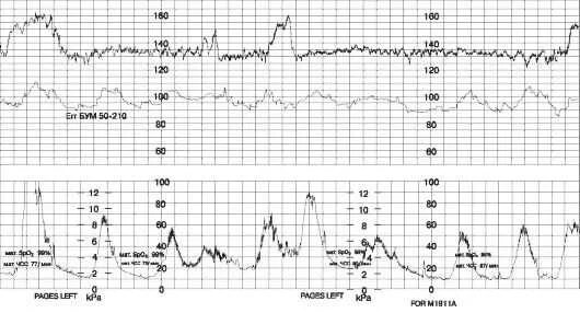 Расшифровка ктг на 33 неделе. Ктг двойни. Оценка параметров ктг. Норма ктг в 31 неделю беременности. Ктг двойни.