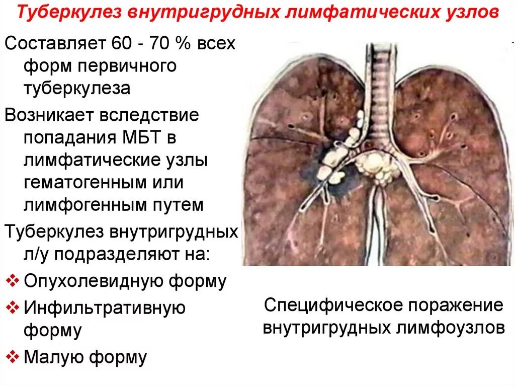 Легкие увеличен узел. Формы туберкулеза внутригрудных лимфатических узлов. Трахеобронхиальные лимфатические узлы. Внутригрудные лимфатические узлы при туберкулезе. Туберкулез внутригрудных лимфоузлов формы.