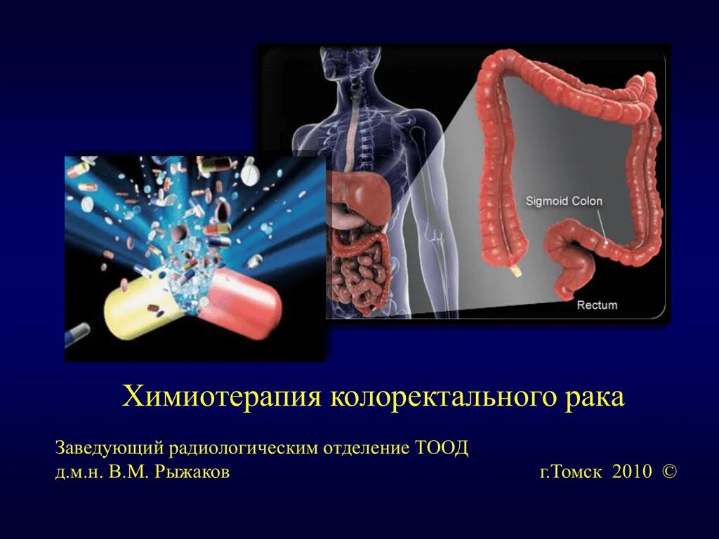 Химиотерапия без рака. Колоректальная карцинома. Фторурацил химиотерапия.