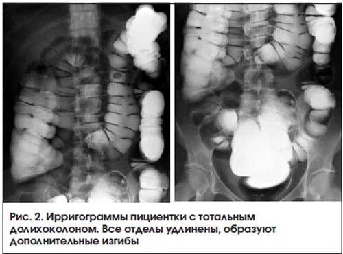 Долихосигма ирригоскопия. Ирригография кишечника долихосигма. Ирригоскопия кишечника долихосигма. Сигмовидная кишка долихосигма. Удлиненная сигмовидная