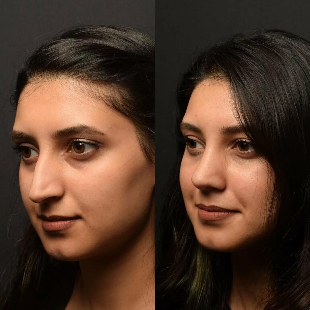 Гадагатль Анзаур Айдамирович ринопластика. Фото ринопластики до и после нос