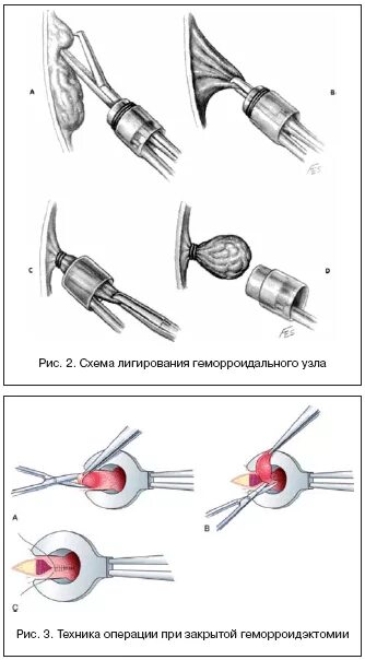 После лигирование геморроидальных узлов. Лигирование геморроидальных узлов (1 узел). Стадии наружного геморроя схема. Лигирование геморроидальных узлов латексными кольцами.