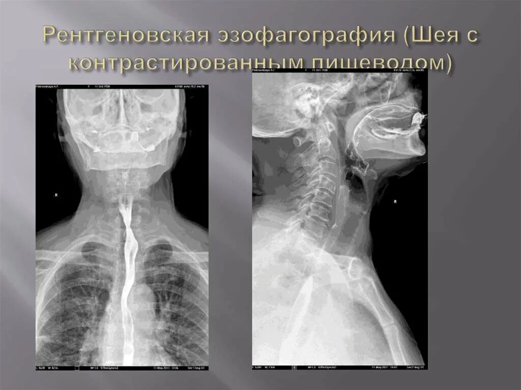 Загрудинный зоб щитовидной железы рентген. Контрастирование пищевода барием. Рентген пищевода (эзофагография). Рентгенография пищевода с контрастом. Пищевод зоб