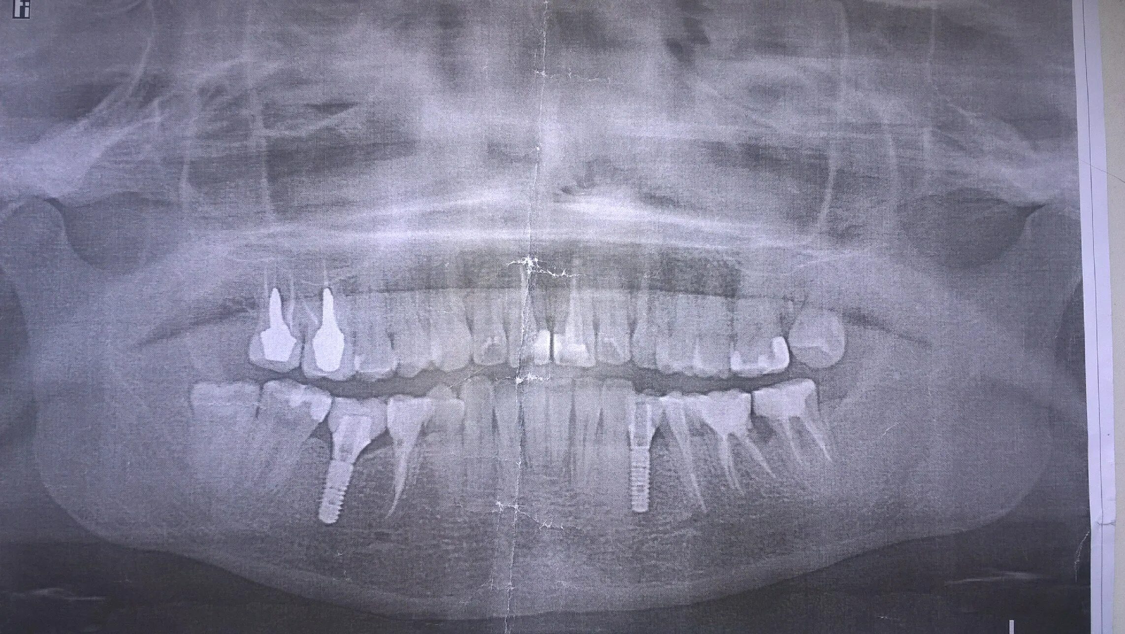 Анатомия корней зубов верхней и нижней челюсти. Как выглядит зуб 7. Как выглядит зуб 7. 7 зуб верхней челюсти. Корни 6 зуба верхней челюсти.