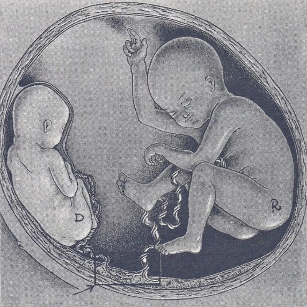 Многоплодная беременность плацента. Многоплодная беременность пуповина. Патологии многоплодной беременности. Аномалия многоплодной беременности. Четверо родов