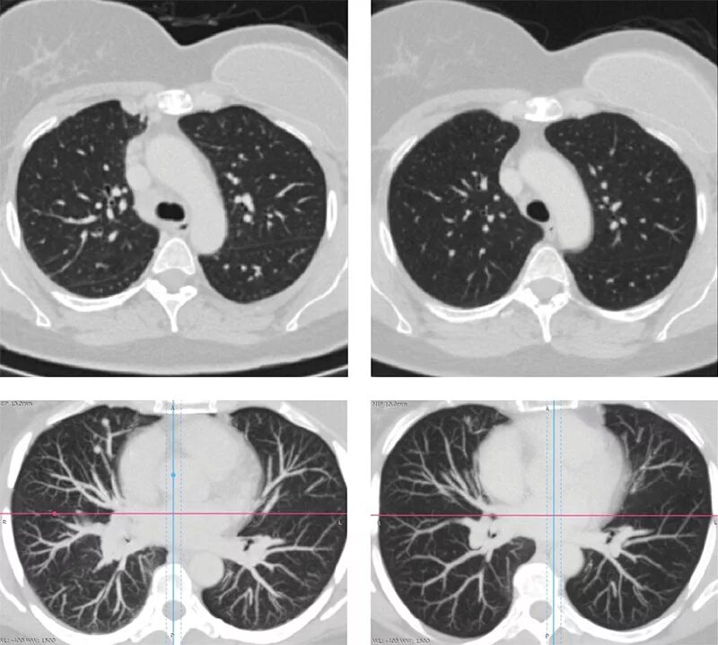 Рак молочной железы метастазы в легких. Множественные метастазы в легких на кт.