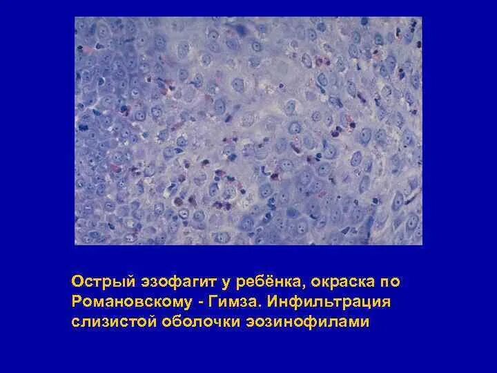 Метод окраски романовского гимзе. Окраска по методу романовского гимза. Метод окраски по романовскому гимза. Окраска по методу романовского гимза. Окраска методом романовского гимза.