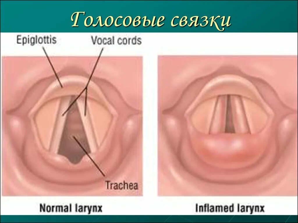 Лечение голосовых связок. Флегмонозный ларингит. Острый катаральный ларингит. Гипертрофический ларингит.