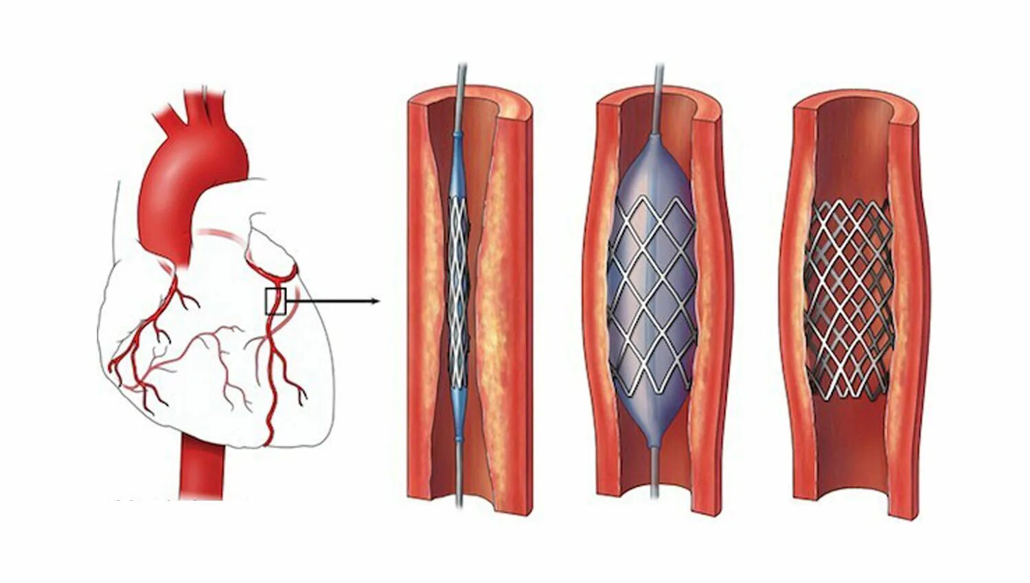 Стент виды. Стентирование сосудов сердца. Коронарная ангиопластика. Стентирование сосудов нижних конечностей. Коронарное стентирование сосудов сердца.