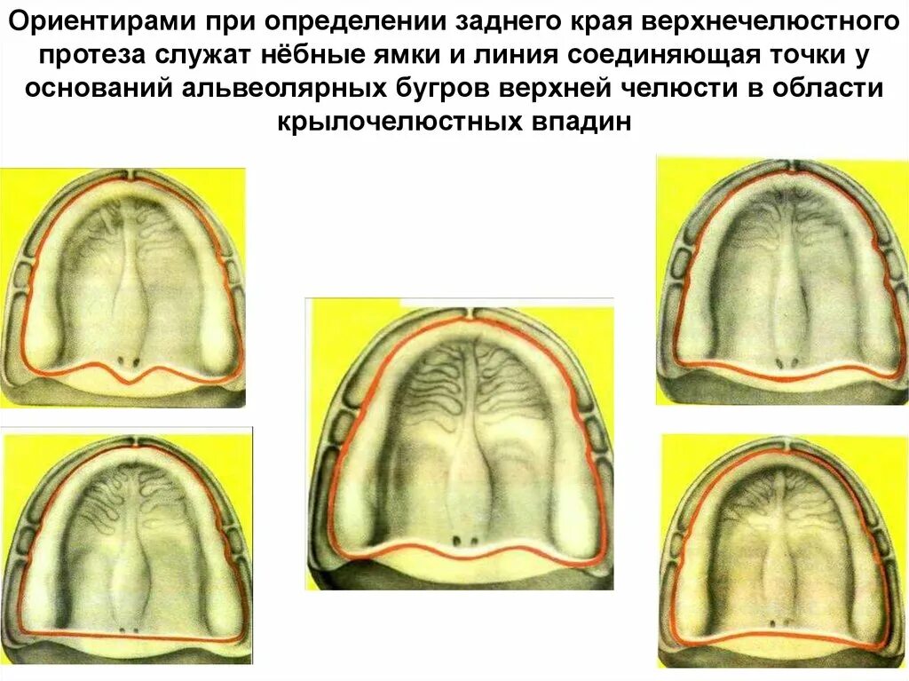 Границы пластиночного протеза. Границы полного съемного протеза на верхней челюсти. Границы полного съемного пластиночного протеза на верхней челюсти. Границы верхнего съемного протеза. Границы базиса протеза на верхней.