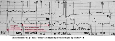 Какой пульс при кардиостимуляторе