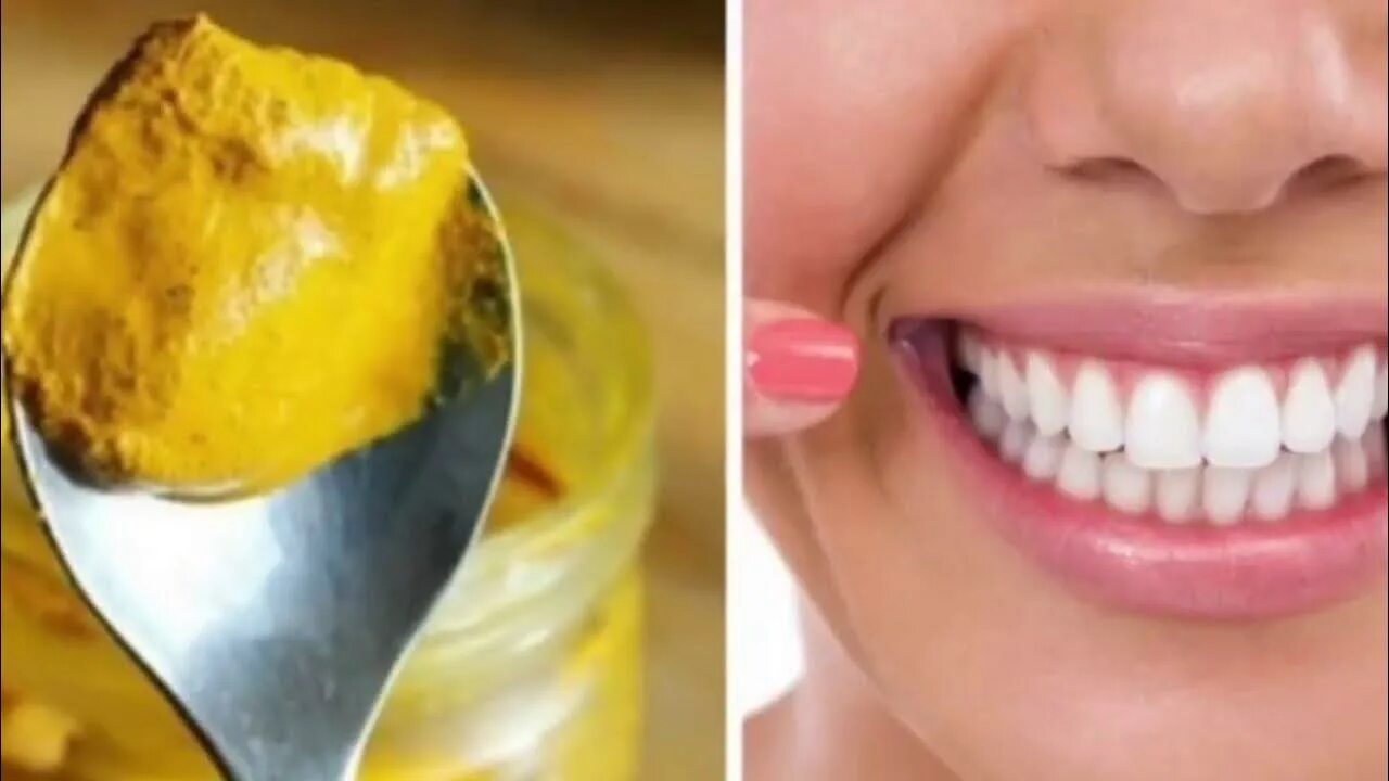 Отбеливание зубов. Желтые очистки