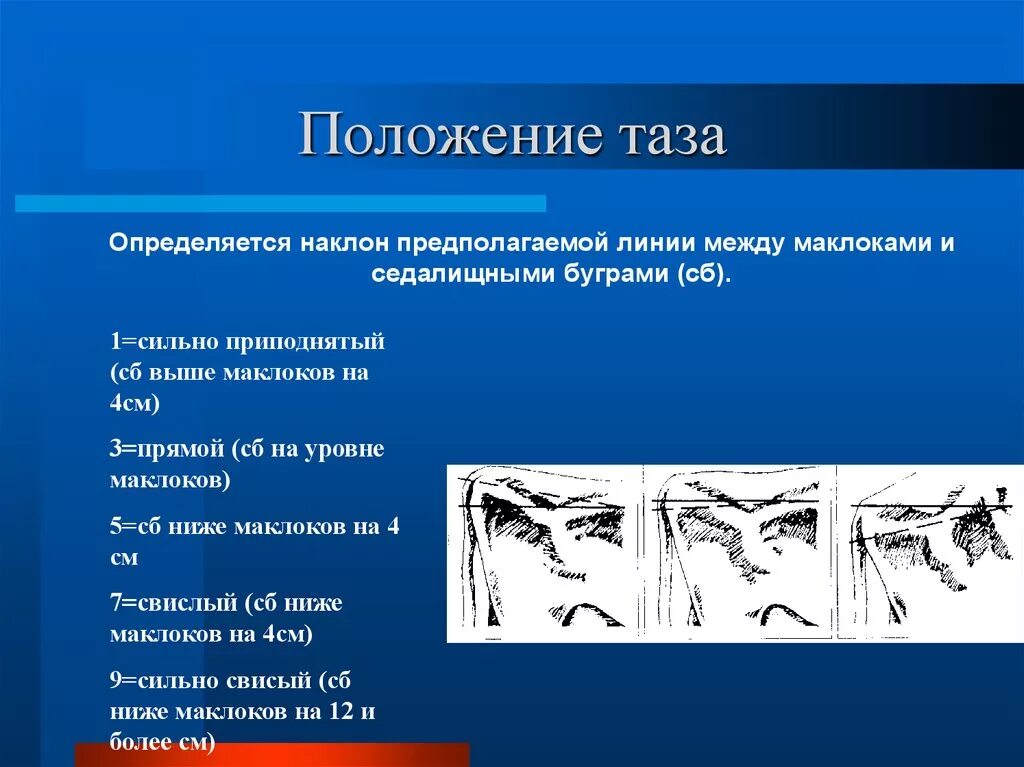 ❗ Наклон таза влияет на состояние мышц спины и позвоночника. ➡ При наклоне таза 