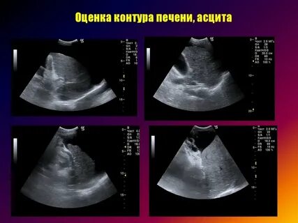 Аэробилия