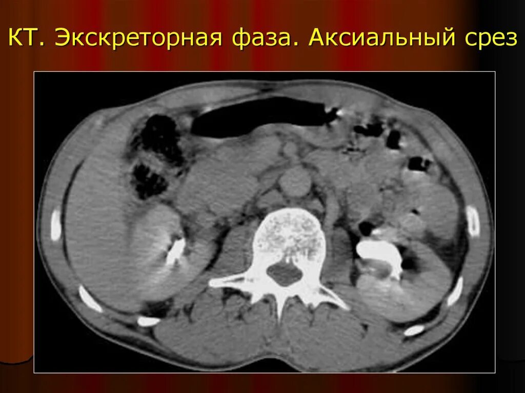Поперечный срез кт. Поперечный срез кт. Кт срезы брюшной полости. Аксиальный срез кт. Кт анатомия брюшной полости.