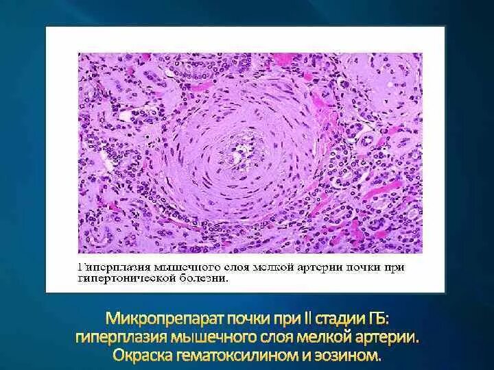 Микропрепарат головного мозга. Гиалиноз артериол головного мозга. Гиалиноз стенки артерии. Гиалиноз сосудов головного мозга окраска гематоксилином и эозином. Гиалиноз сосудов почки микропрепарат.