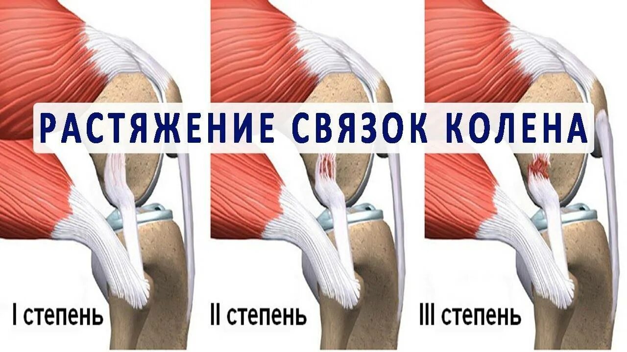 Травмы мышц и сухожилий. Растяжение коленных связок. Колено растяжение связки колена. Растяжение мышц и сухожилий. Разрыв связок коленного сустава.