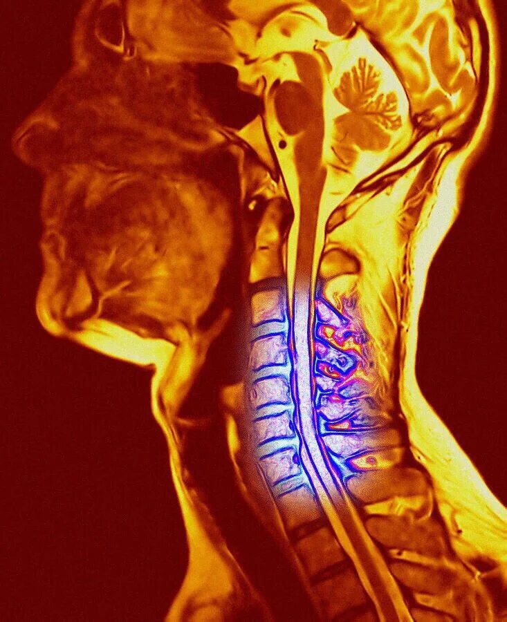 Хандрос сильная боль. Полисегментарный остеохондроз позвоночника что это. Остеохондроз шейного отдела позвоночника. Миелит патоморфология. Остеохожрлзшейного отдела.
