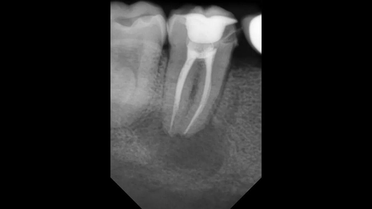 Периодонтит эндодонтия. Гранулирующий периодонтит рентгенограмма. Апикальный периодонтит. Периодонтит корневые каналы. Временное пломбирование корневых