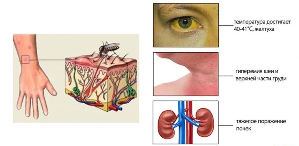 Клинические проявления при желтой лихорадке. Желтая геморрагическая лихорадка патогенез. Наиболее характерные симптомы желтой лихорадки. Вирус желтой лихорадки симптомы. Сохраняющиеся лихорадка