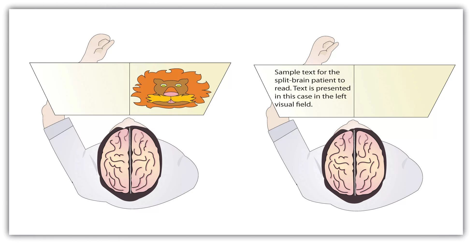 Split brain. Синдром расщепленного мозга. Газзанига расщепленный мозг. Эксперимент Сперри и Газзанига.